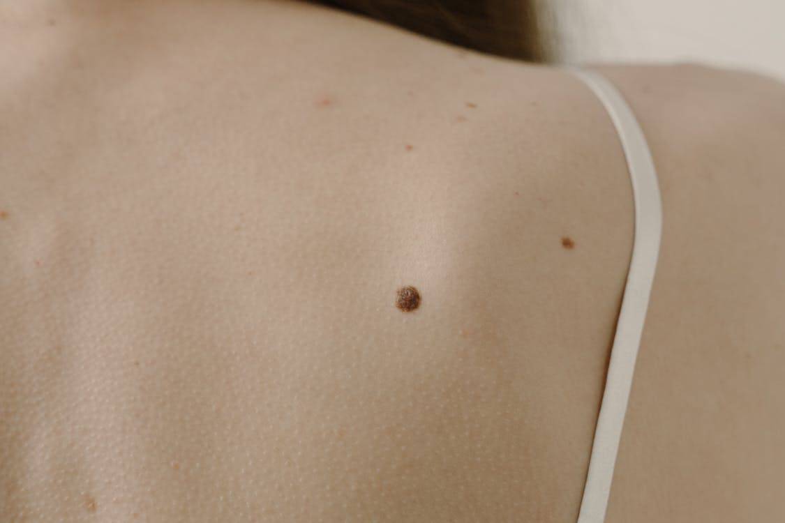 A Vaccine for Melanoma Is Moving Through Trials, With Australians Among the First